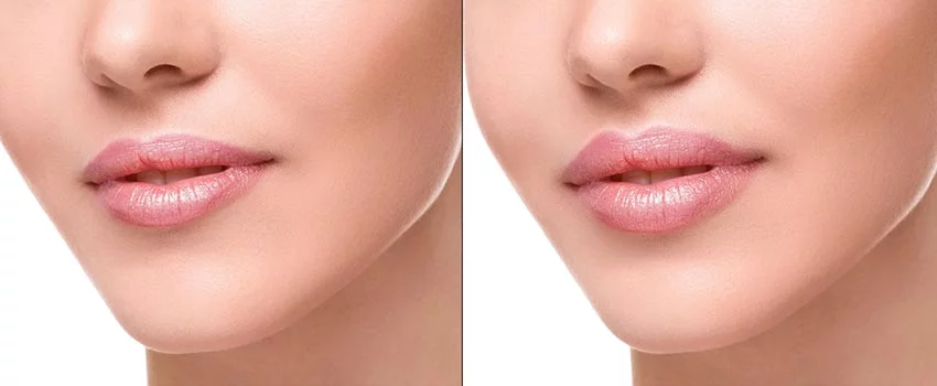 Lip Filler Treatment in Woodbury, MN