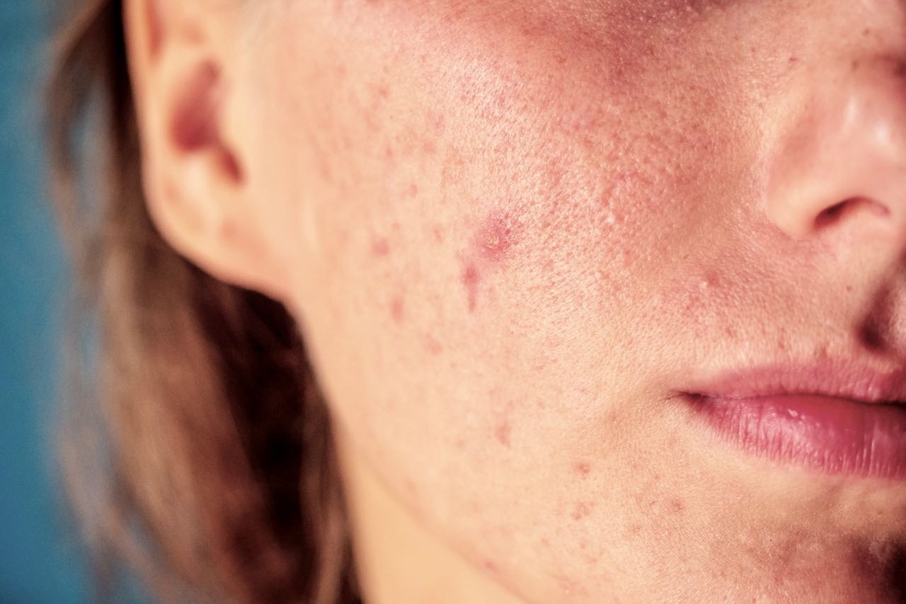 5 Reasons You’re Breaking Out in Summer (And How to Fix It)