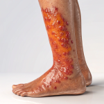 Cellulogia (Cellulitis) – Symptoms, Causes, and Treatment of Skin Infection